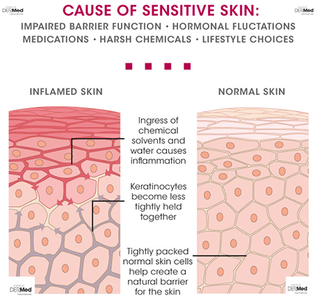 Understanding Rosacea