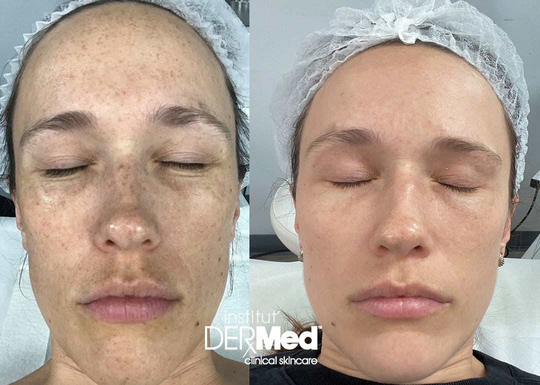 Institut_Dermed_before_and_after_classic_peel