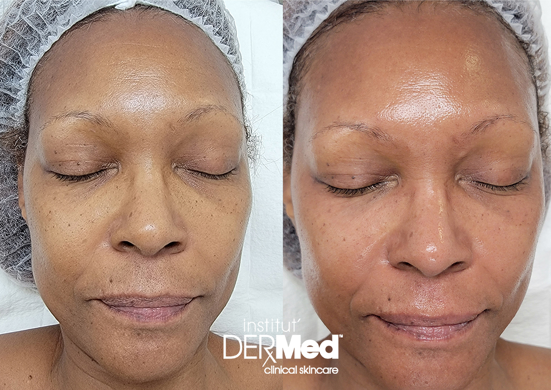 before_and_after_Institut_Dermed_TCA_Peel