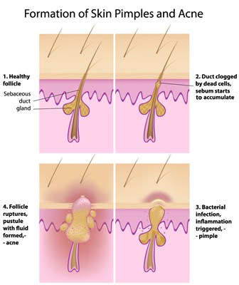 formation of acne web