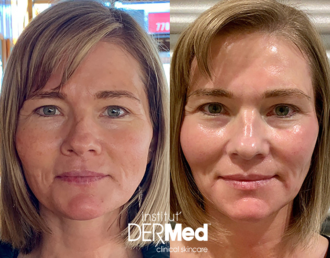 institut_dermed_chemical_peel_before_after